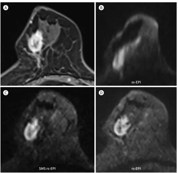 Fig. 6. A 71-year-old woman with multifocal invasive ductal carcinoma of the right breast
