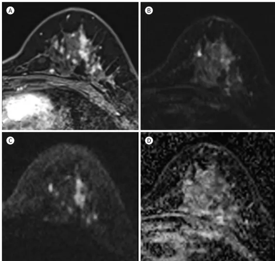 Fig. 3. A 47-year-old woman with ductal carcinoma in situ (nuclear grade 2). 