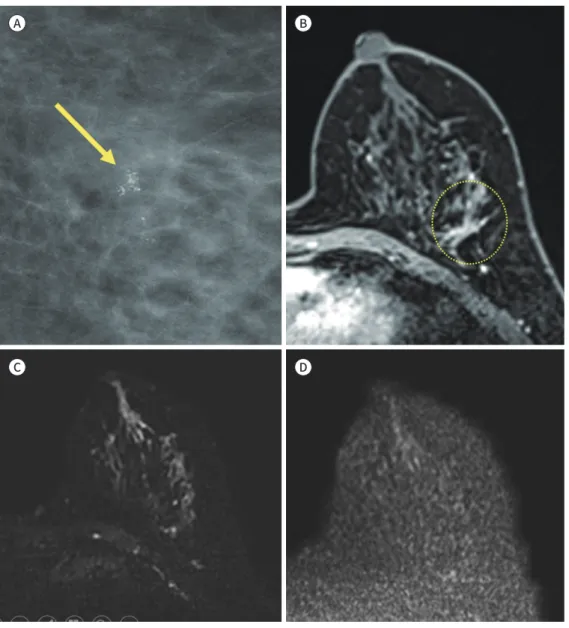 Fig. 4. A 51-year-old woman with ductal carcinoma in situ in the left breast. 