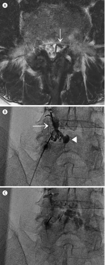 Fig. 1. Fluoroscopy-guided facet joint synovial cyst rupture in a 64-year-old  female.