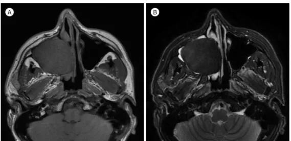 Fig. 1. A 38-year-old man with primary fibrous meningioma of the maxillary sinus.