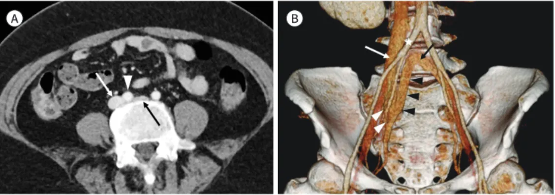 Fig. 1. Iatrogenic iliac vein injury with May-Thurner syndrome in a 53-year-old woman.