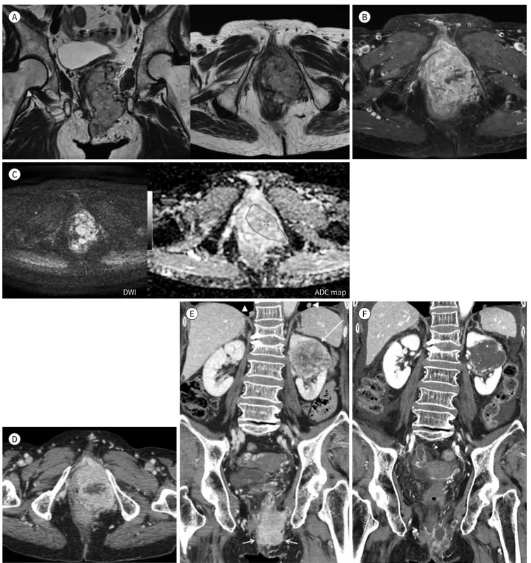 Fig. 1. 76-year-old female with a palpable left perineal metastatic renal cell carcinoma.