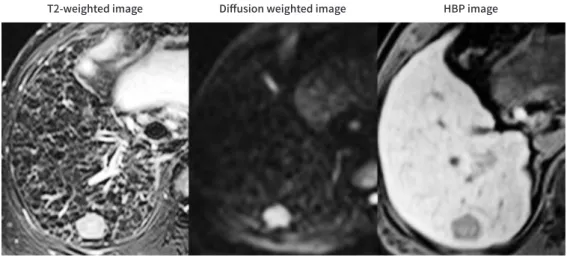 Fig. 4. An example of abbreviated MRI using HBP image for HCC surveillance. Axial MR images in a 43-year- 43-year-old male with chronic hepatitis B demonstrate a 2.1-cm observation in segment 6 that shows mild  hyper-intensity on the T2-weighted and diffus