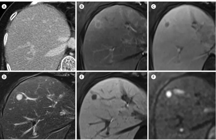 Fig. 6. Margin-negative resection of borderline resectable pancreatic head cancer with aortocaval lymph node metastasis