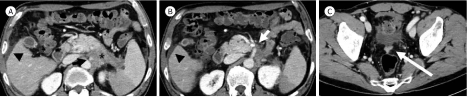 Fig. 8. Pancreatic tail cancer with peritoneal metastasis in CT. 