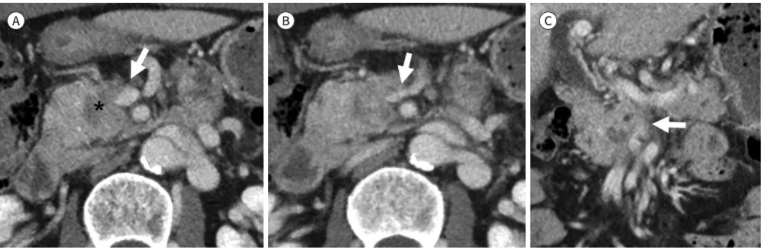 Fig. 3. Deformity and segmental resection of the SMV. 