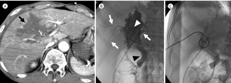 Fig. 5. Biliary tract injury in a 51-year-old man who had a car accident. 