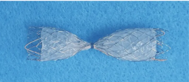 Fig. 1. A silicone-covered bronchial  occluder (BOD, S&amp;G Biotech,  Seong-nam, Korea) with a wine-glass  config-uration