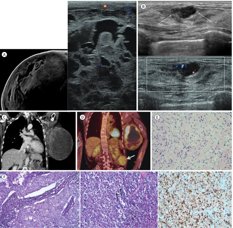 Fig. 1. Imaging and pathologic features of bilateral breast cancer in a 49-year-old woman with neurofibromatosis type 1.