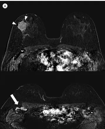 Fig. 1. Progressive transformation of  germinal centers in axillary lymphnodes  after breast cancer surgery in a  32-year-old female.