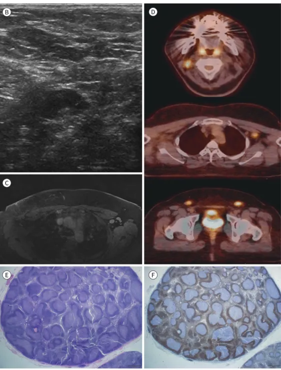 Fig. 1. Progressive transformation of germinal centers in axillary lymphnodes after breast cancer surgery in  a 32-year-old female.