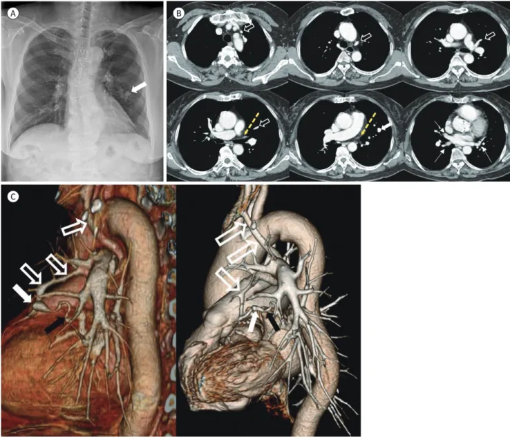 Fig. 1. Levoatriocardinal vein combined with pulmonary venous varix in a 77-year-old woman, presenting with chest abnormalities on screening.