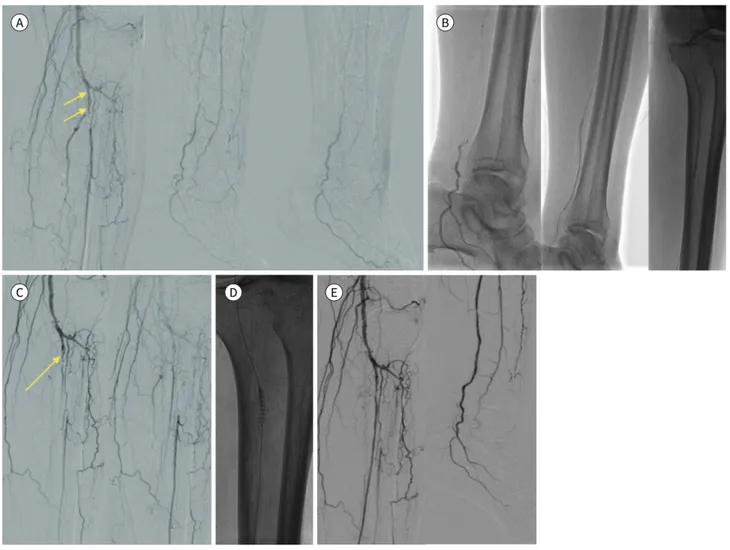 Fig. 3. A 74-year-old male patient with diabetic foot in the right leg.