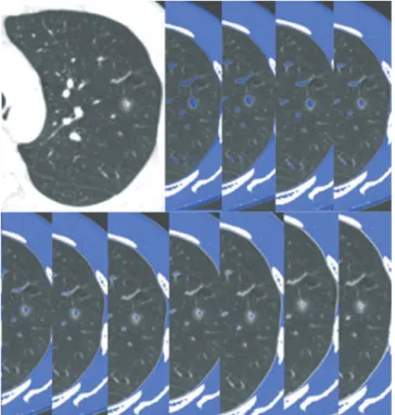 Fig. 1. Measurement of the largest diameter of the solid portion on axial  images.