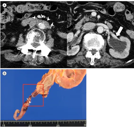Fig. 5. IgG4-related retroperitoneal fibrosis.