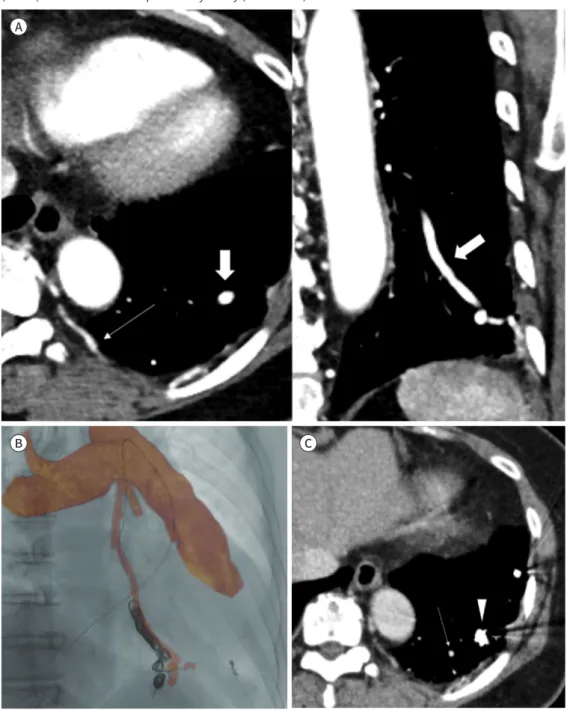Fig. 1. A 67-year-old female with mild dyspnea presented with systemic-to-pulmonary artery fistula.