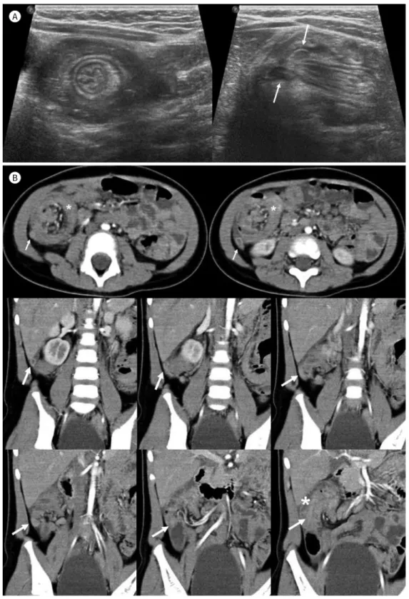 Fig. 1. A 35-month-old girl presenting with recurrent intussusception with acute appendicitis.