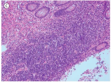 Fig. 1. A 35-month-old girl present- present-ing with recurrent intussusception  with acute appendicitis.