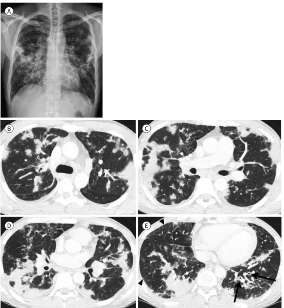 Fig. 5. Eosinophilic granulomatosis with polyangiitis in a 32-year-old male.
