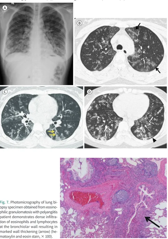 Fig. 7. Photomicrography of lung bi- bi-opsy specimen obtained from  eosino-philic granulomatosis with polyangiitis  patient demonstrates dense  infiltra-tion of eosinophils and lymphocytes  at the bronchiolar wall resulting in  marked wall thickening (arr