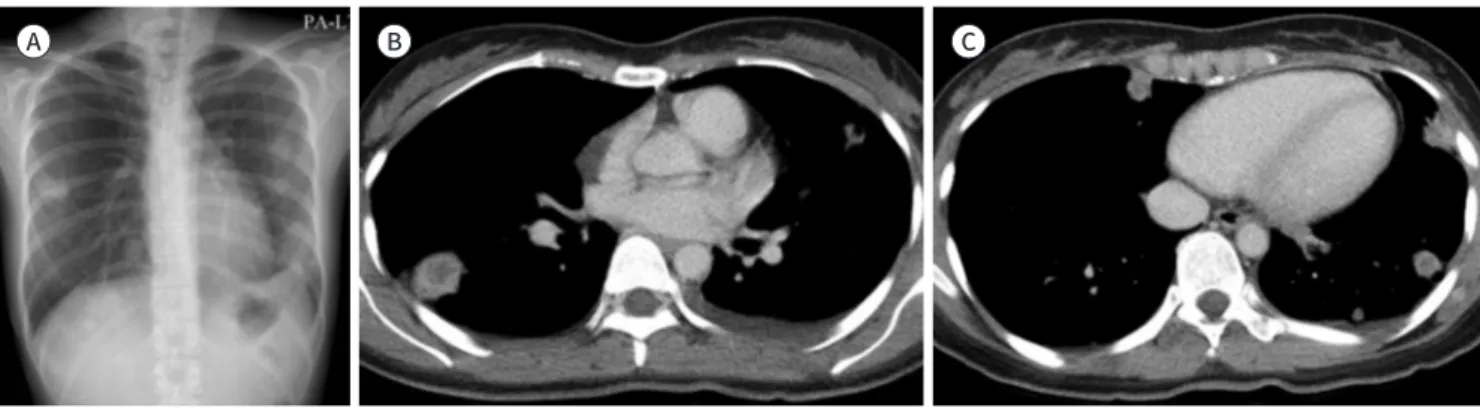 Fig. 3. Granulomatosis with polyangiitis in a 30-year-old female.