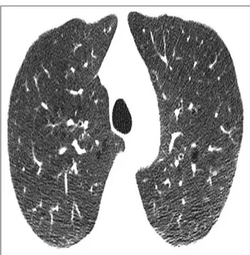 Fig. 1. Mild centrilobular emphysema. 
