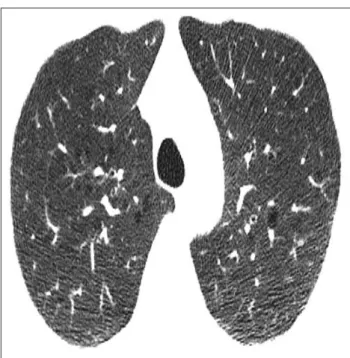 Fig. 1. Mild centrilobular emphysema. 