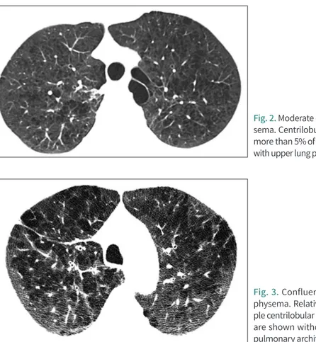 Fig. 2. Moderate centrilobular emphy- emphy-sema. Centrilobular lucencies involve  more than 5% of the lung parenchyma,  with upper lung predominance.