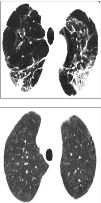 Fig. 4. Advanced destructive emphyse- emphyse-ma. Large, panlobular lucencies with  distortion of the pulmonary  architec-ture and the hyperexpansion of  second-ary pulmonsecond-ary lobules are shown.