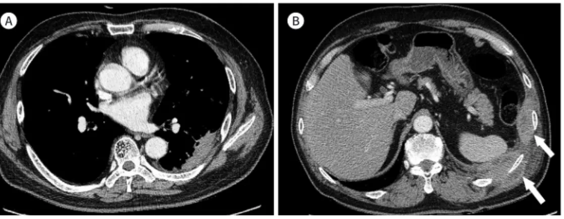 Fig. 4. A 64-year-old male with immunoglobulin G4-related disease presenting with a chest wall mass at the  sternoclavicular joint.