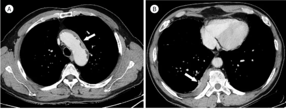 Fig. 5. Immunoglobulin G4-related aortitis and periaortitis, and paravertebral soft tissue in a 65-year-old  male