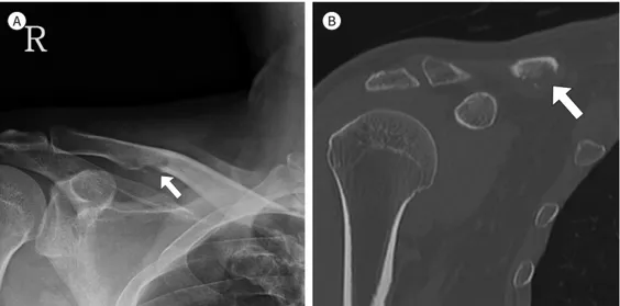 Fig. 1. A 51-year-old male with Langerhans cell histiocytosis in the mid-portion of right clavicle.
