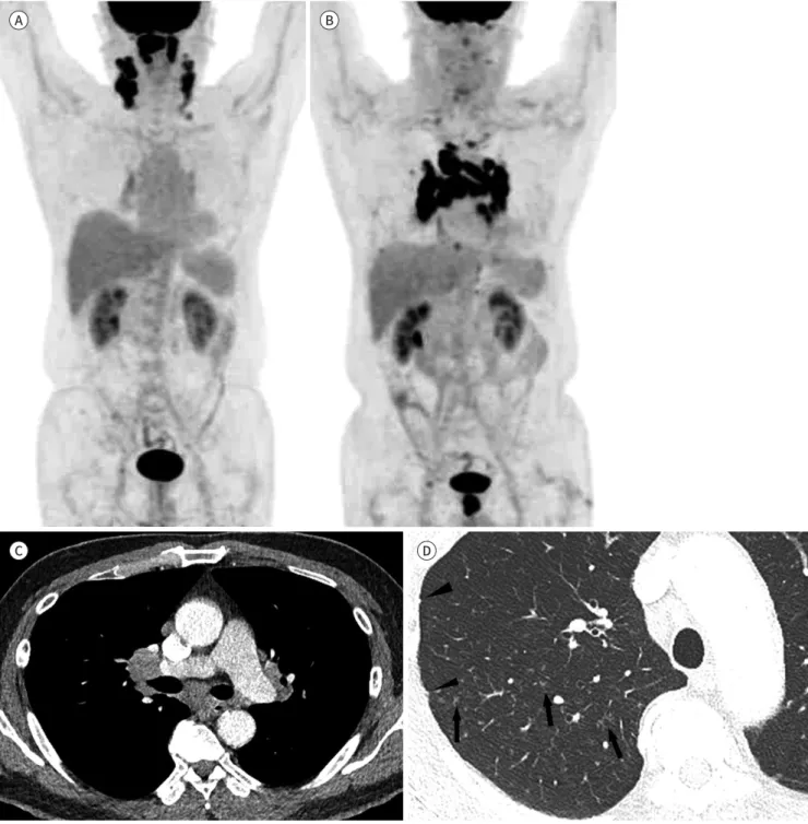 Fig. 1. A 56-year-old male with nasopharyngeal cancer and a sarcoid-like reaction (patient 2).