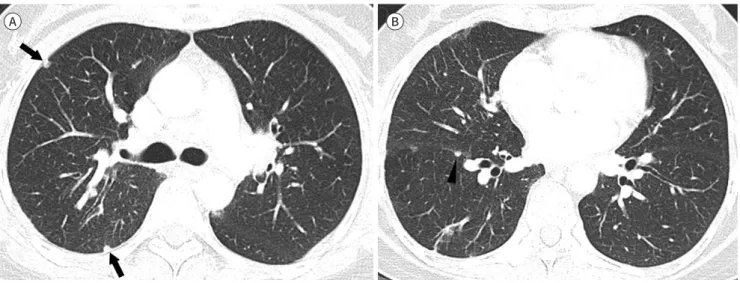 Fig. 3. A 49-year-old female with marginal zone B-cell lymphoma in the nasal cavity and a sarcoid-like reaction (patient 5)