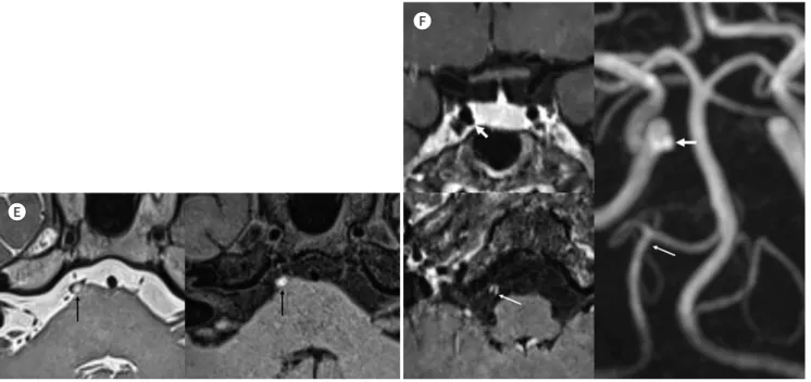 Fig. 1. Pontine Infraction as an initial manifestation of systemic lupus erythematosus in a 20-year-old female