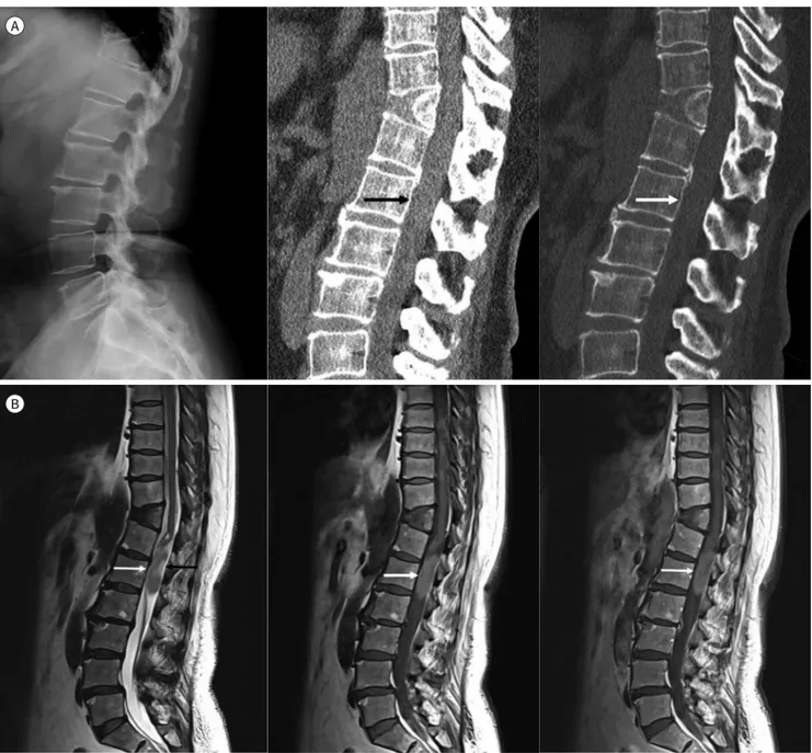 Fig. 1. A 52-year-old female with spinal intradural extramedullary ependymoma.