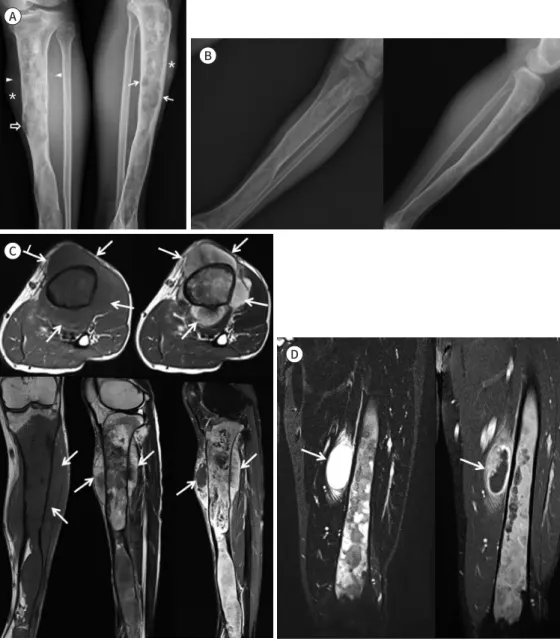 Fig. 1. A case of a 50-year-old male with malignant transformation of Mazabraud syndrome on the left tibia.