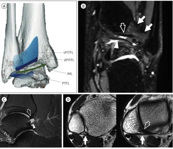 Fig. 14. Posteroinferior tibiofibular ligament complex.