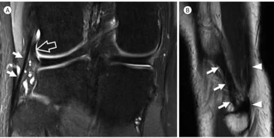 Fig. 3. Popliteofibular ligament and popliteomeniscal fascicle.