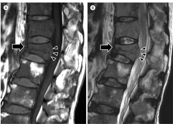 Fig. 2. Pathologic fracture in a 71-year-old man with non-small cell lung cancer. 