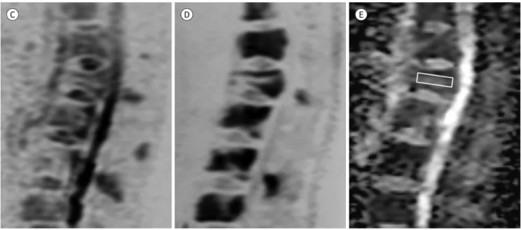 Fig. 2. Pathologic fracture in a 71-year-old man with non-small cell lung cancer. 