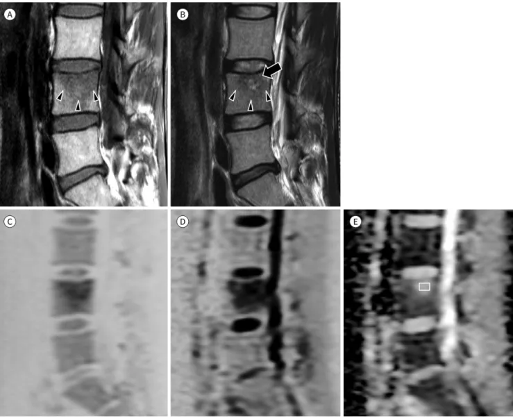 Fig. 3. Bone marrow edema adjacent to a Schmorl’s node in a 24-year-old man with low back pain