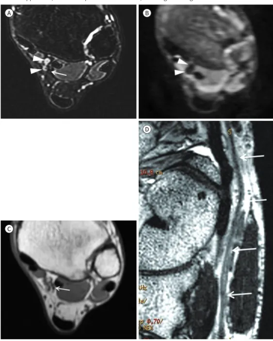 Fig. 13. MR images of the tibial nerve within the tarsal tunnel. 