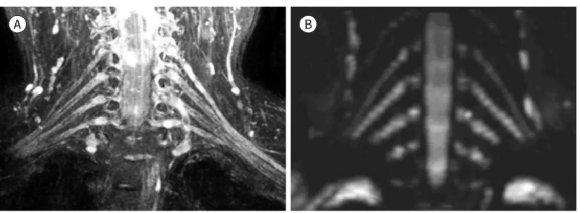 Fig. 1. MR neurography of the normal brachial plexus. 