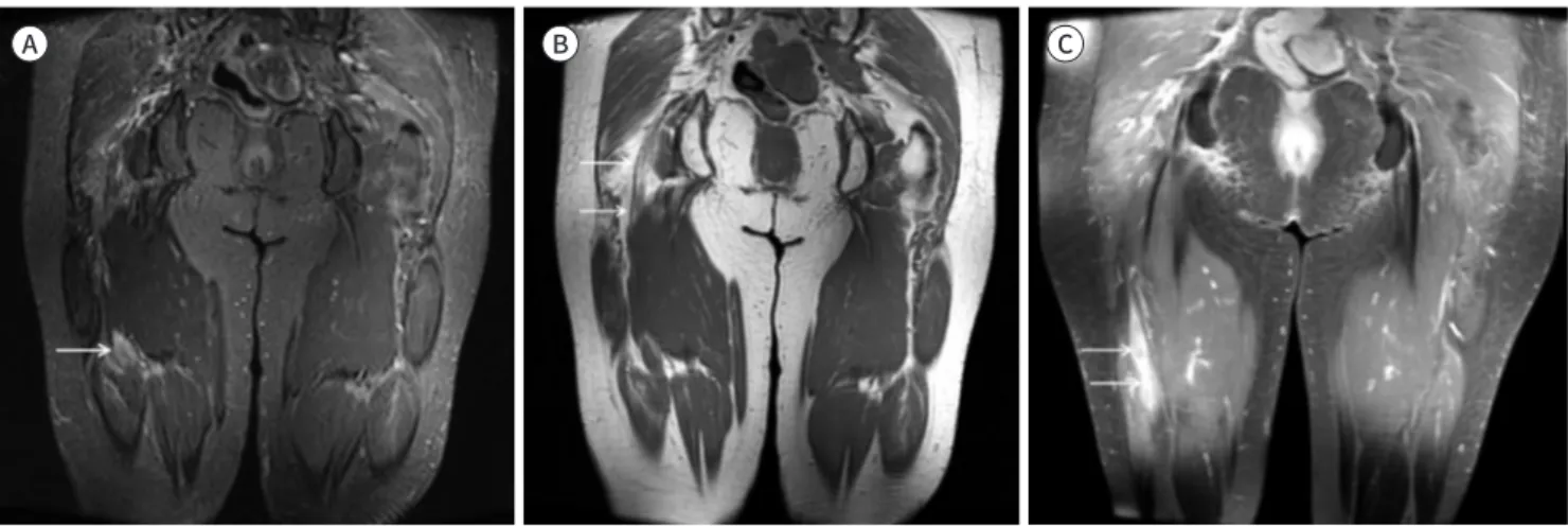 Fig. 4. A 64-year-old women with lymphoma involving right sciatic nerve. 