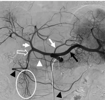 Fig. 1. Celiac trunk angiogram before transarterial chemoembolization  of hepatocellular carcinoma in a 62- year-old man