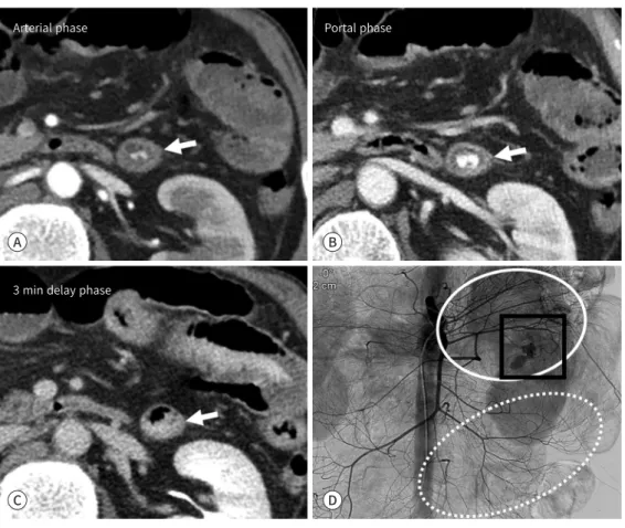 Fig. 4. Massive hematochezia in a 56-year-old man.
