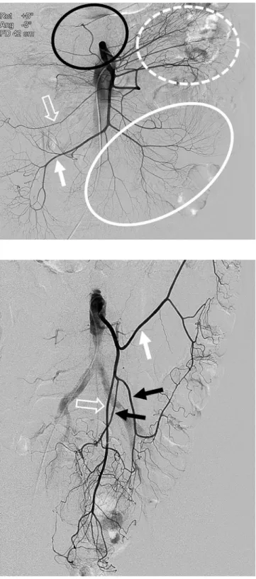 Fig. 5. Superior mesenteric angiogram for suspected active bleeding  from a jejunal branch in a 56-year-old man.
