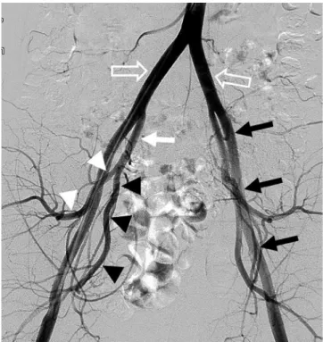 Fig. 7. The abdominal aorta divides into the common iliac arteries  (empty arrows).